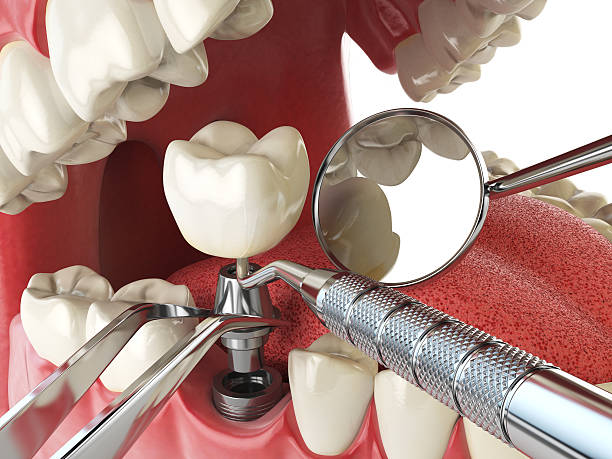 Best Emergency Tooth Extraction in Hampton, GA